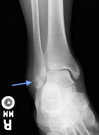 Weber A Fracture