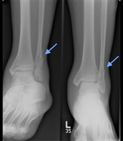 pilon fracture