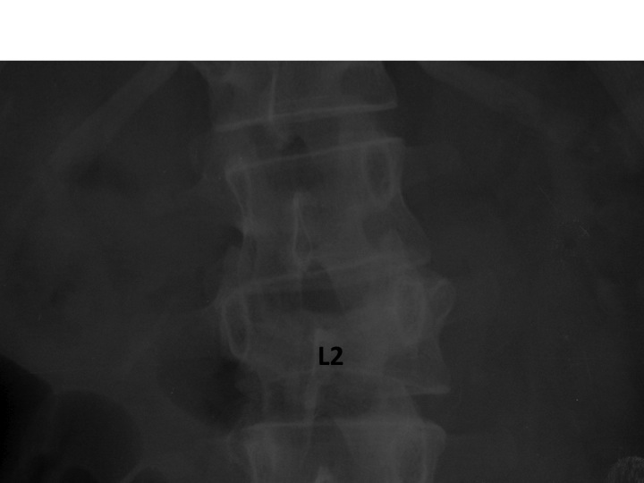 Spine Case 1 Answer Orthopedic Teaching Feinberg School Of Medicine 1862