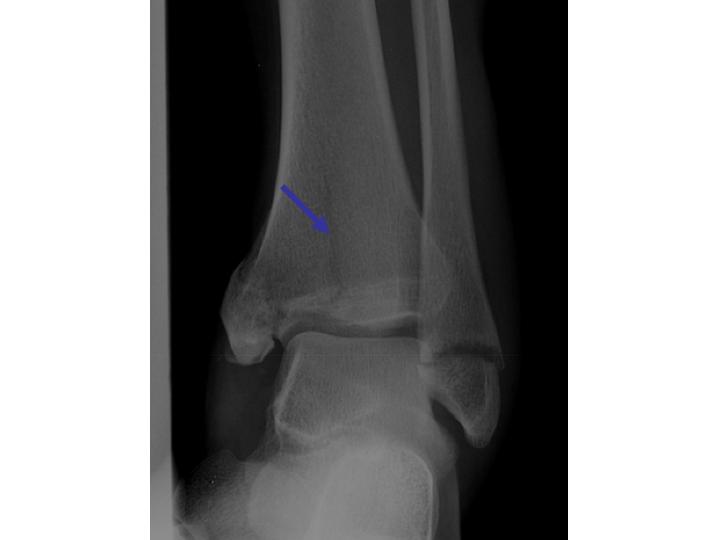 pilon fracture