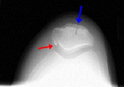 Leg/Knee Case 3 Additional Images: Orthopedic Teaching: Feinberg School ...